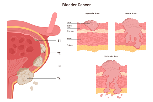 Bladder cancer